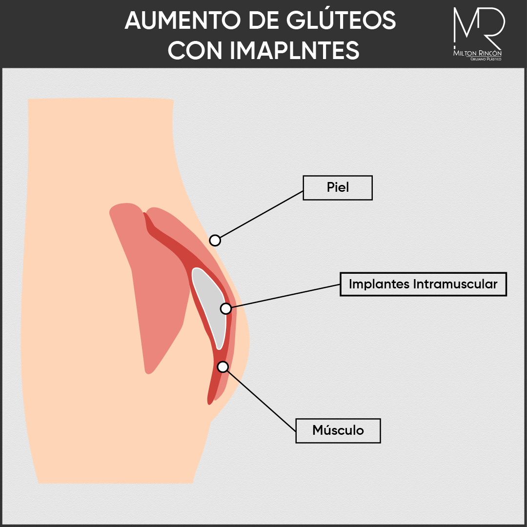 Evolución de abdominoplastia